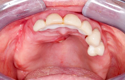 Beispiele: Schwellung mit Eiter (Abszess)