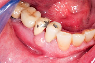 Beispiele: Schwellung mit Eiter (Abszess)