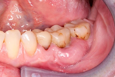 Beispiele: Schwellung mit Eiter (Abszess)