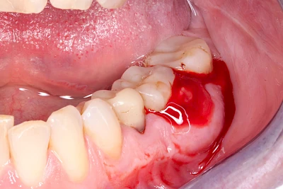 Beispiele: Schwellung mit Eiter (Abszess)