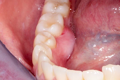 Beispiele: Schwellung mit Eiter (Abszess)