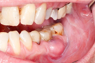 Beispiele: Schwellung mit Eiter (Abszess)