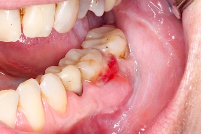 Beispiele: Schwellung mit Eiter (Abszess)