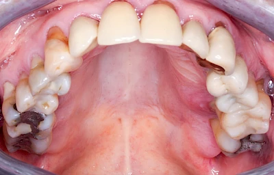 Beispiele: Schwellung mit Eiter (Abszess)