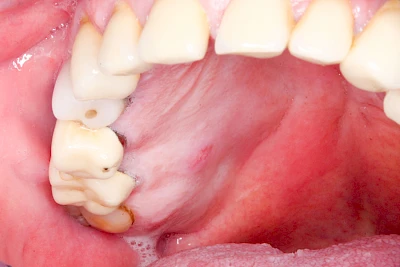 Beispiele: Schwellung mit Eiter (Abszess)
