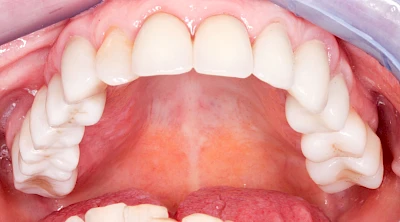 Beispiele: Schwellung mit Eiter (Abszess)