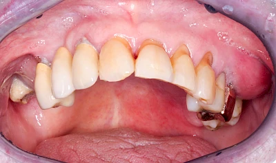 Beispiele: Schwellung mit Eiter (Abszess)