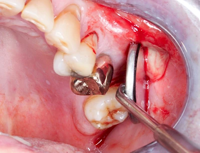 Beispiele: Schwellung mit Eiter (Abszess)