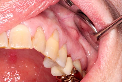 Beispiele: Schwellung mit Eiter (Abszess)