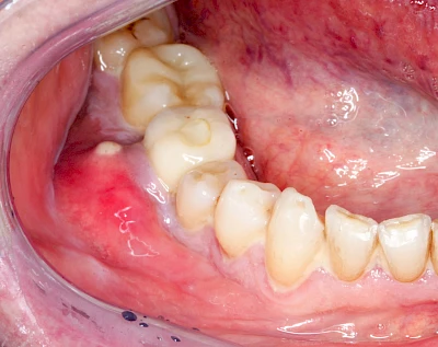 Beispiele: Schwellung mit Eiter (Abszess)