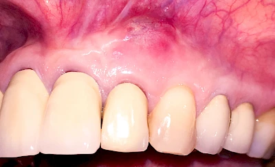 Beispiele: Schwellung mit Eiter (Abszess)