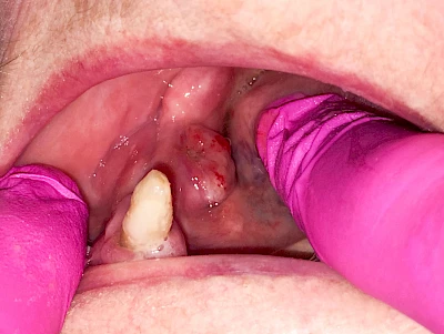 Beispiele: Schwellung mit Eiter (Abszess)