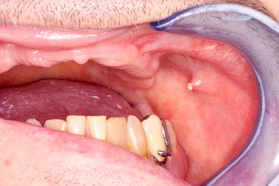 Beispiele: Schwellung mit Eiter (Abszess)