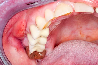 Beispiele: Schwellung mit Eiter (Abszess)