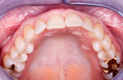 Beispiele: Schwellung mit Eiter (Abszess)