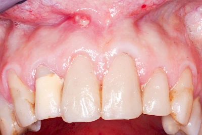 Beispiele: Schwellung mit Eiter (Abszess)