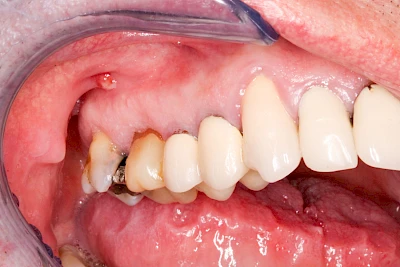 Beispiele: Schwellung mit Eiter (Abszess)