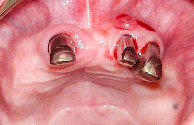 Beispiele: Schwellung mit Eiter (Abszess)