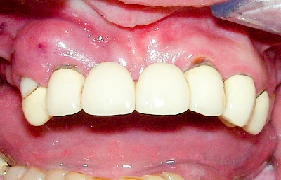 Beispiele: Schwellung mit Eiter (Abszess)