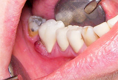 Beispiele: Schwellung mit Eiter (Abszess)