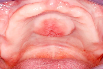 Beispiele: Schwellung ohne Eiter (kugelförmig)