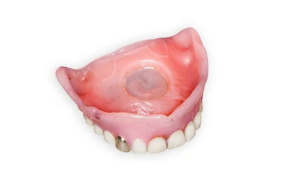 Beispiele: Schwellung ohne Eiter (kugelförmig)