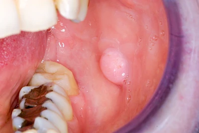 Beispiele: Schwellung ohne Eiter (kugelförmig)