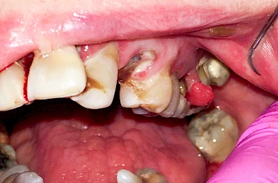 Beispiele: Schwellung ohne Eiter (kugelförmig)