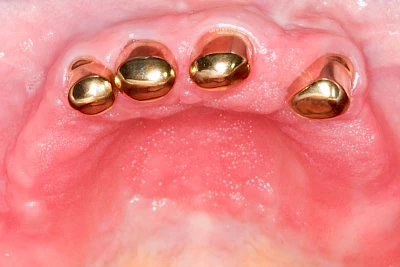 Beispiele: Schwellung ohne Eiter (kugelförmig)