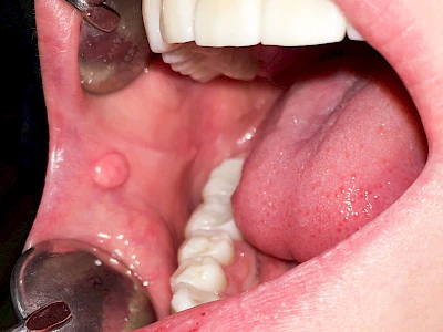 Beispiele: Schwellung ohne Eiter (kugelförmig)