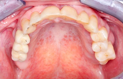 Beispiele: Schwellung ohne Eiter (kugelförmig)