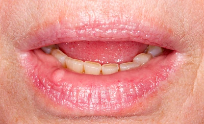 Beispiele: Schwellung ohne Eiter (kugelförmig)