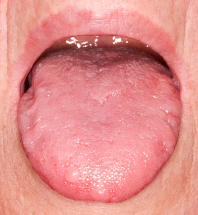 Beispiele: Schwellung ohne Eiter (kugelförmig)