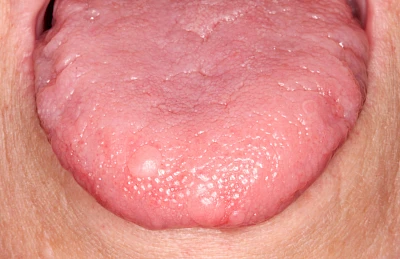 Beispiele: Schwellung ohne Eiter (kugelförmig)