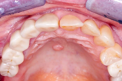 Beispiele: Schwellung ohne Eiter (kugelförmig)