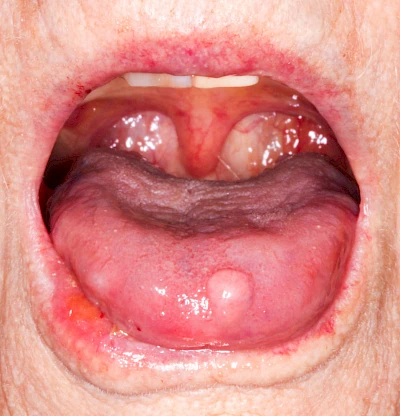 Beispiele: Schwellung ohne Eiter (kugelförmig)