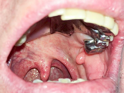 Beispiele: Schwellung ohne Eiter (kugelförmig)