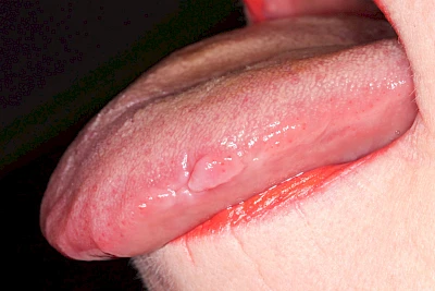 Beispiele: Schwellung ohne Eiter (kugelförmig)