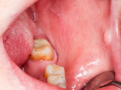 Beispiele: Schwellung ohne Eiter (kugelförmig)