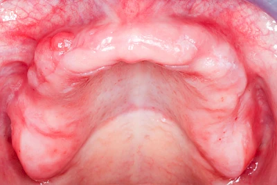 Beispiele: Schwellung ohne Eiter (kugelförmig)