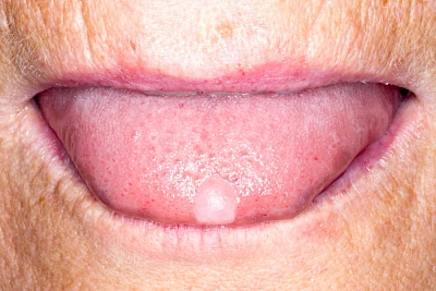 Beispiele: Schwellung ohne Eiter (kugelförmig)