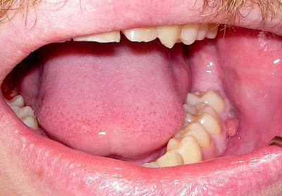 Beispiele: Schwellung ohne Eiter (kugelförmig)