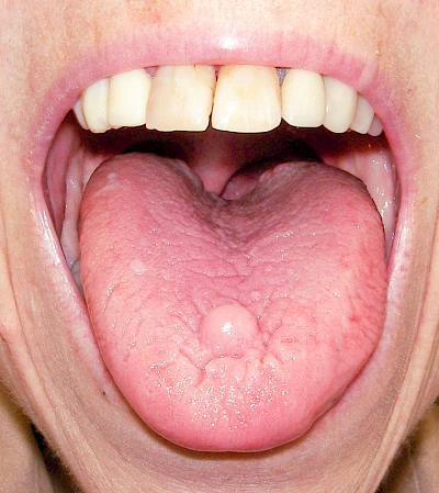 Beispiele: Schwellung ohne Eiter (kugelförmig)