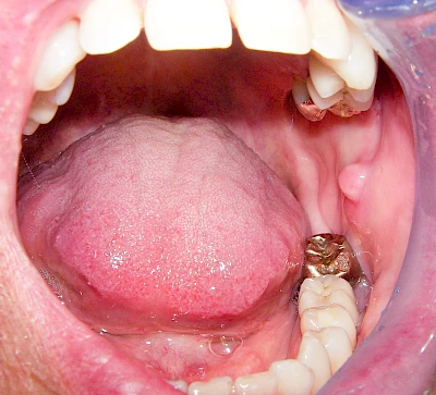 Beispiele: Schwellung ohne Eiter (kugelförmig)