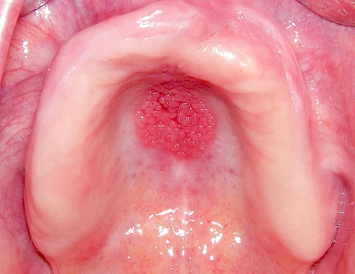 Beispiele: Schwellung ohne Eiter (kugelförmig)