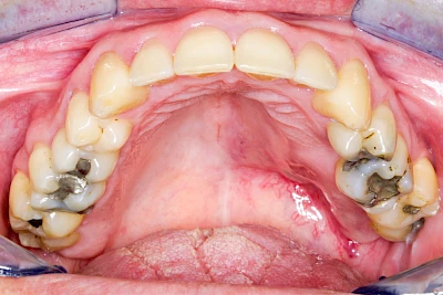 Beispiele: Einschmelzung & Geschwür