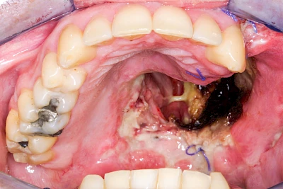 Beispiele: Einschmelzung & Geschwür