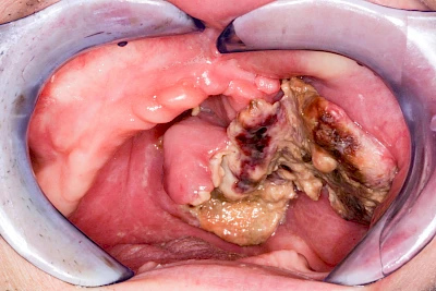 Beispiele: Einschmelzung & Geschwür
