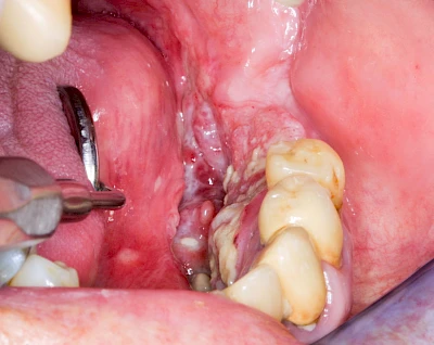 Beispiele: Einschmelzung & Geschwür