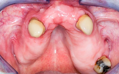 Beispiele: Einschmelzung & Geschwür
